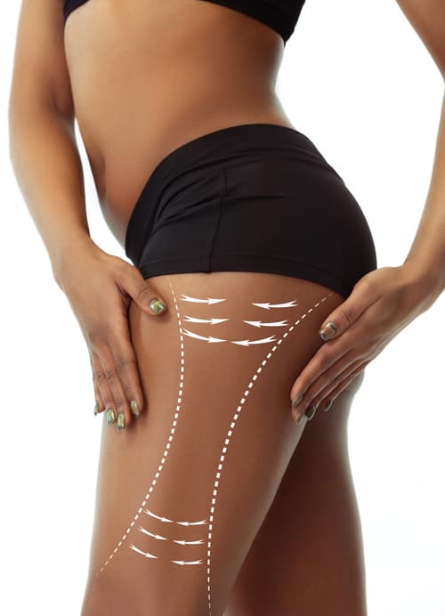 Trattamento Carbossiterapia